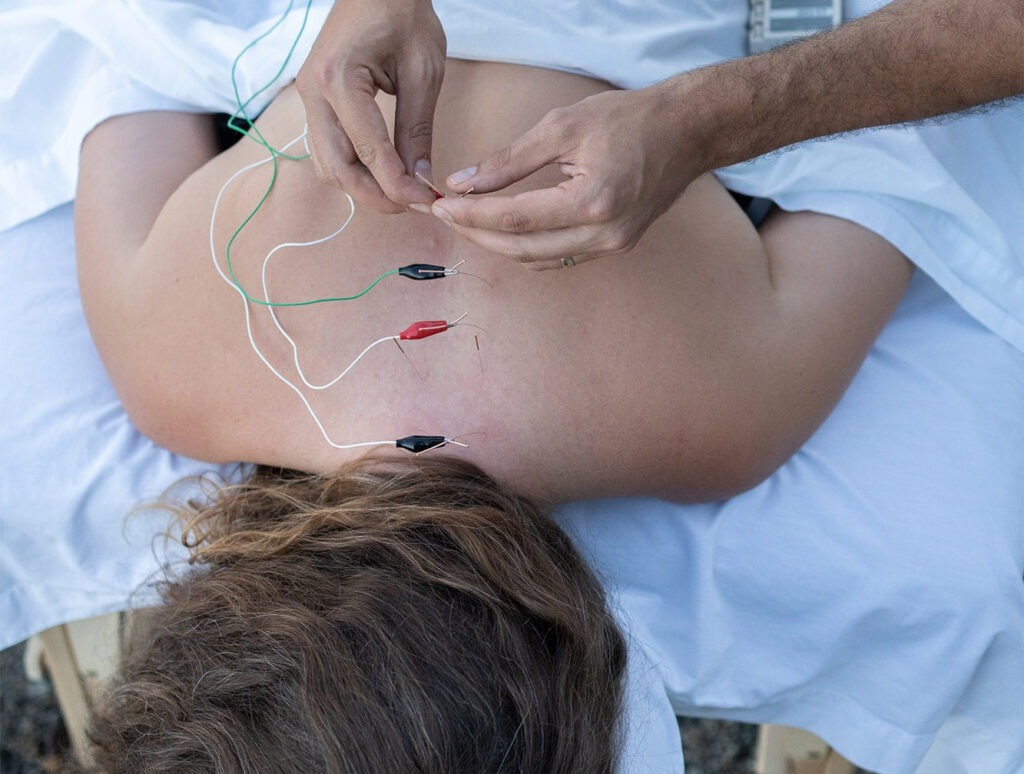 Neuromodulation percutanée échoguidée au cabinet PhysioÉvolution — vue 1