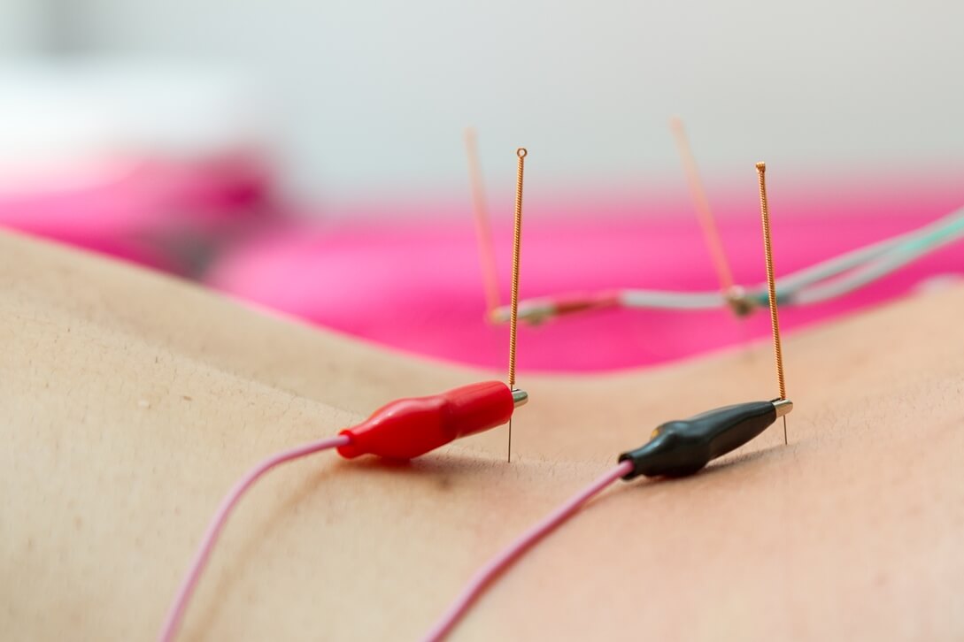 Neuromodulation percutanée échoguidée au cabinet PhysioÉvolution — vue 2